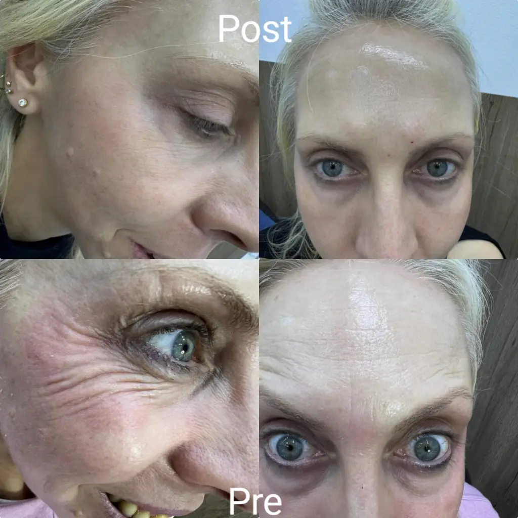 Botox to get rid of wrinkles around the eyes