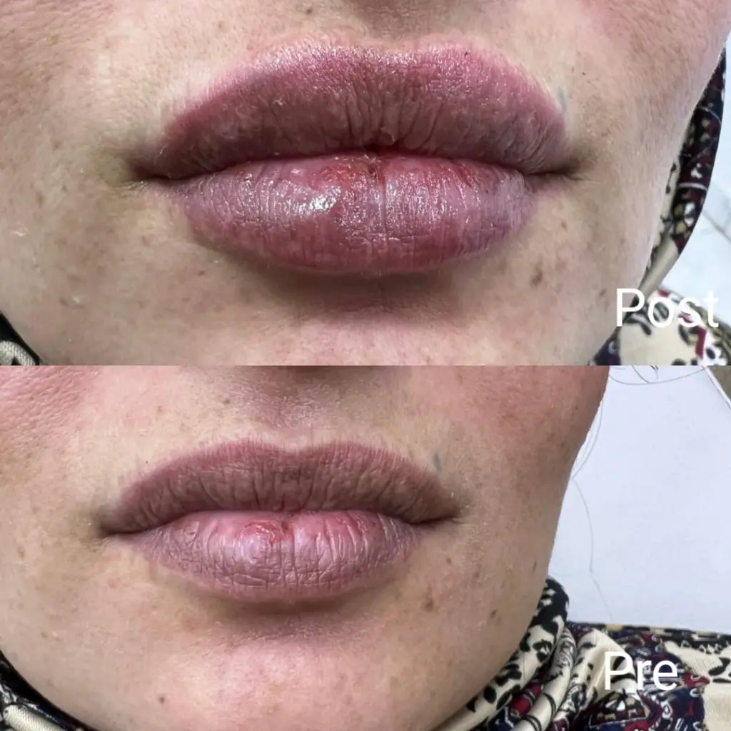 Lip augmentation with fillers