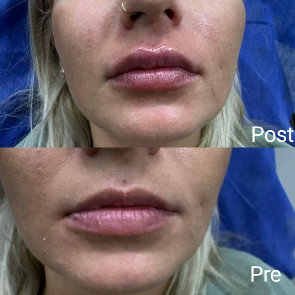 Lip augmentation and plumping with fillers