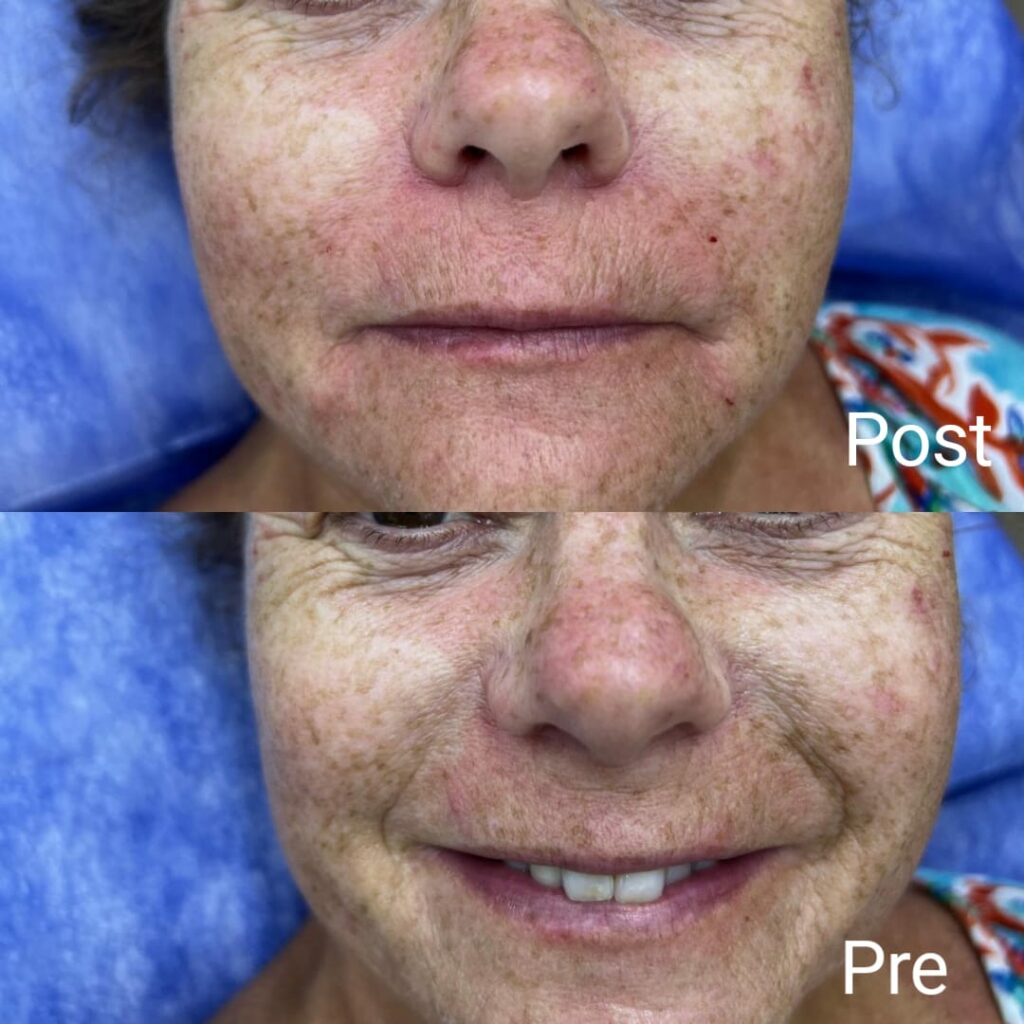 Facial filler or smile lines