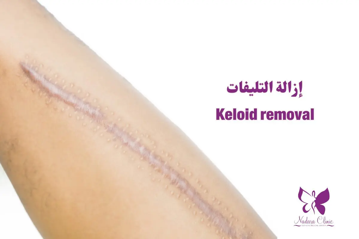 Keloid removal in Hurghada