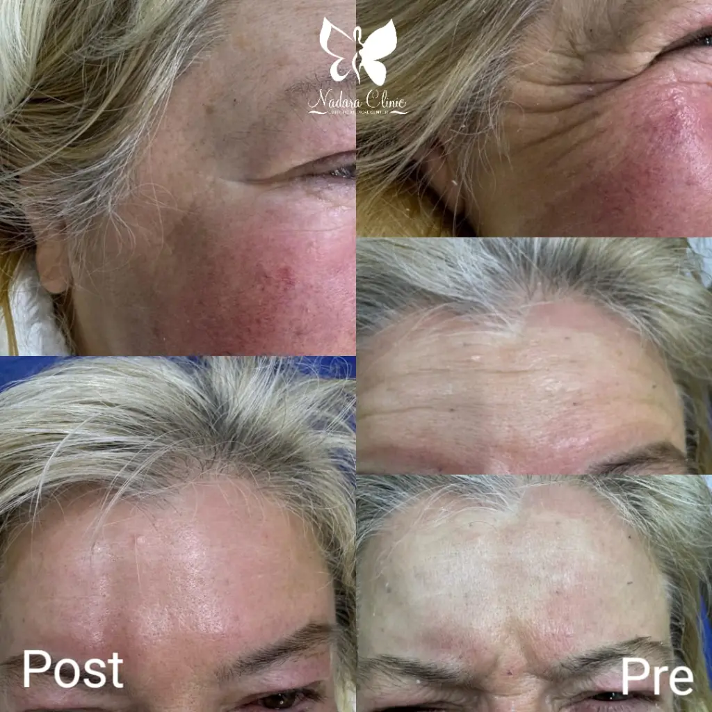 Facial Botox before and after