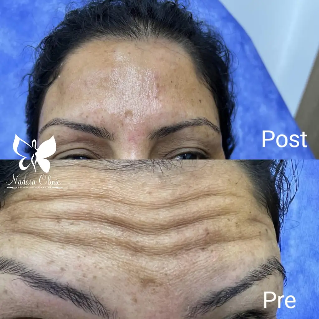 Botox Dysport forehead