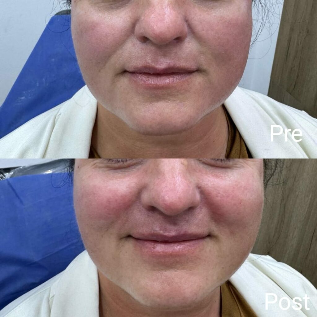 Facial and lip augmentation with hyaluron