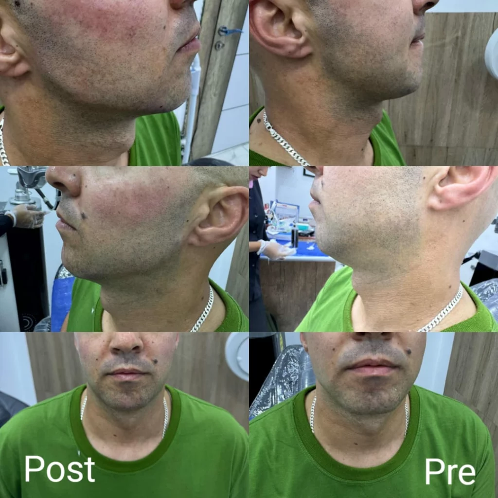 Jaw definition and chin drawing with fillers