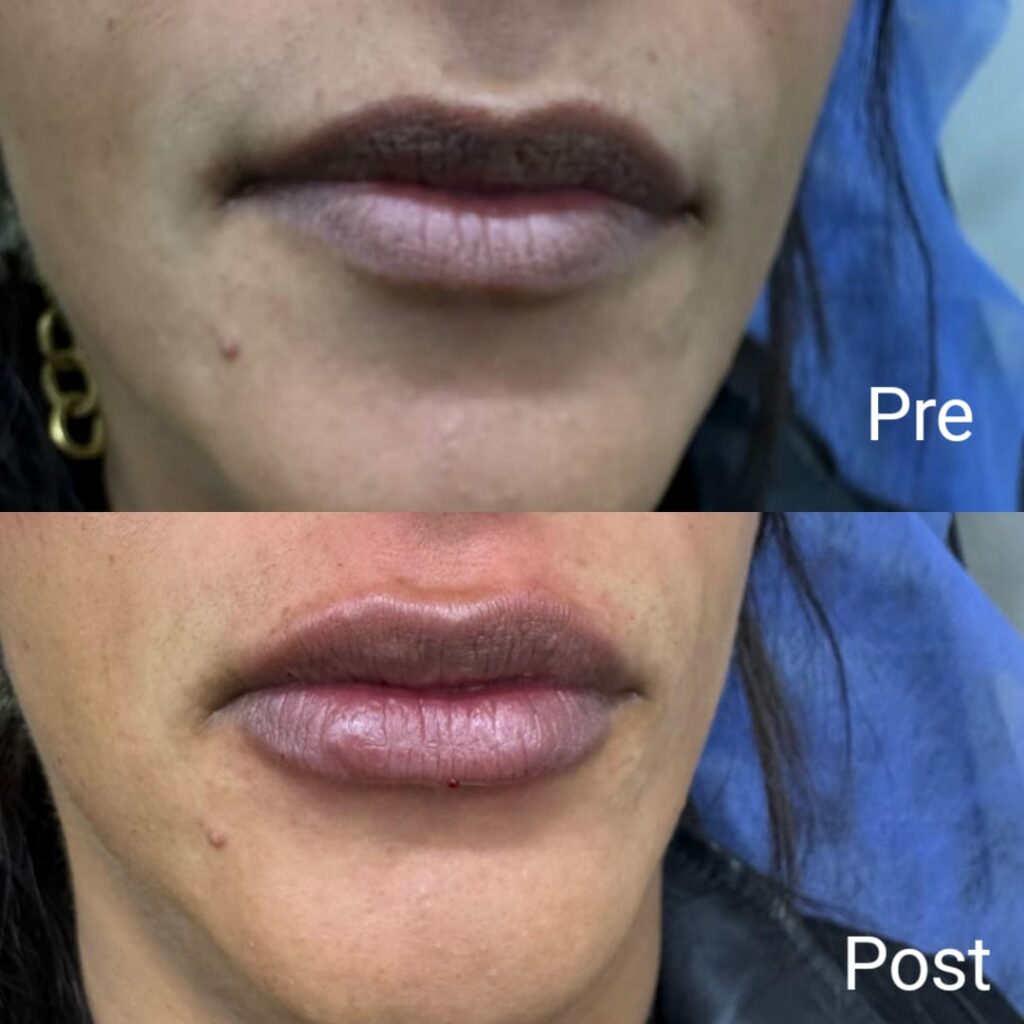 Lip augmentation and beautification with fillers