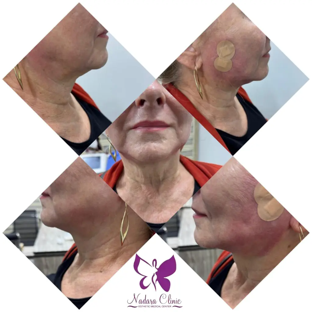 Facelift with threads before and after