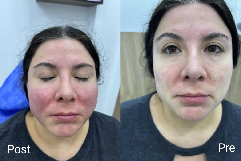 Cheek lift with threads, immediate results and improvement within 10 days