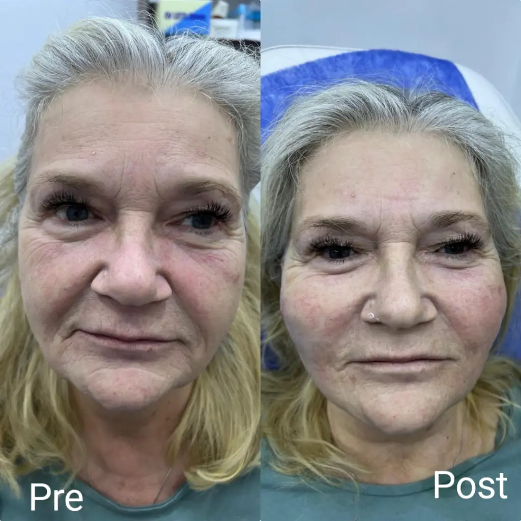 Facelift and cheek lift with threads