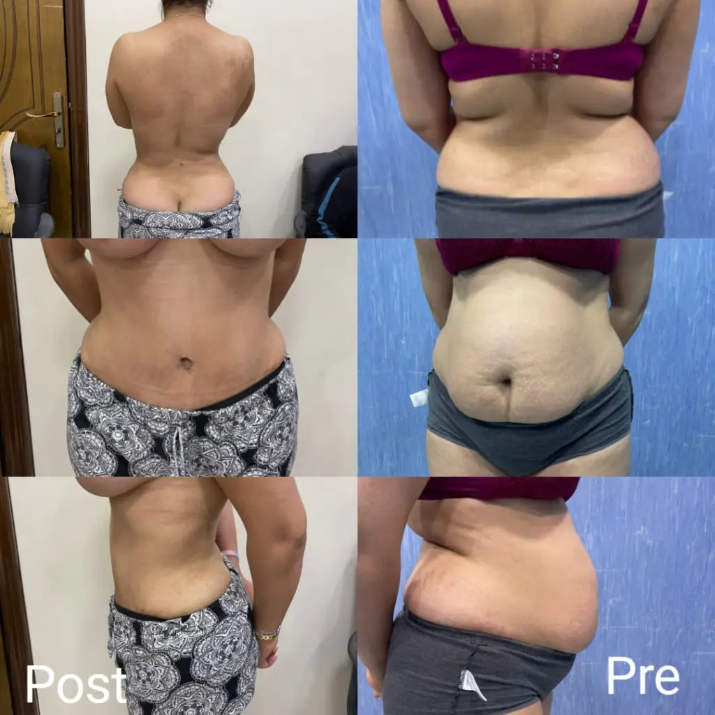 Liposuction in Egypt