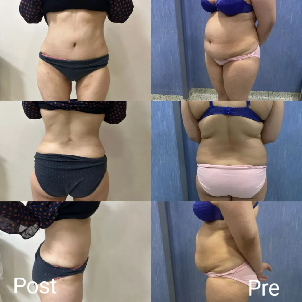 Liposuction before and after