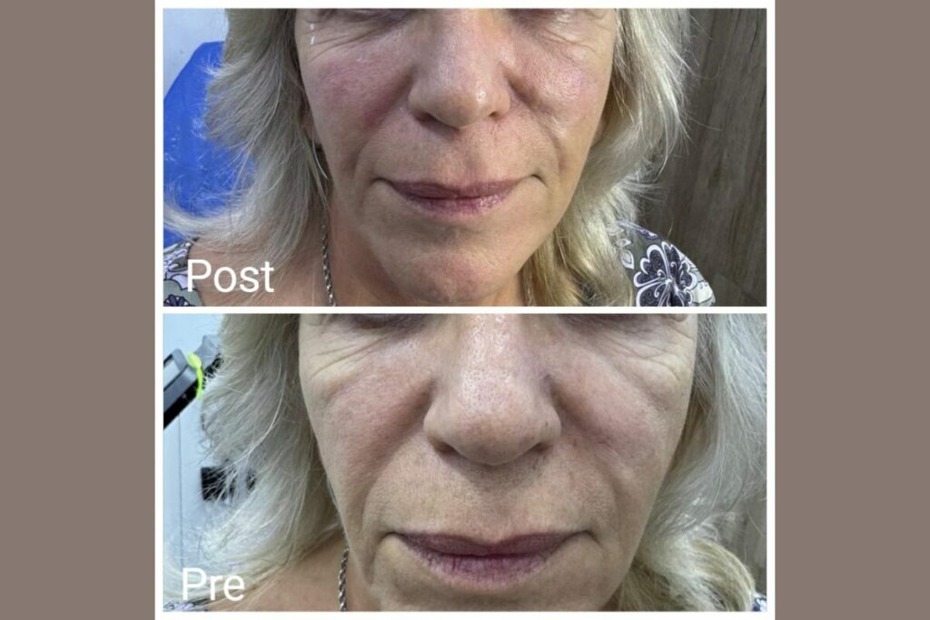 فيلر الوجه في الغردقة