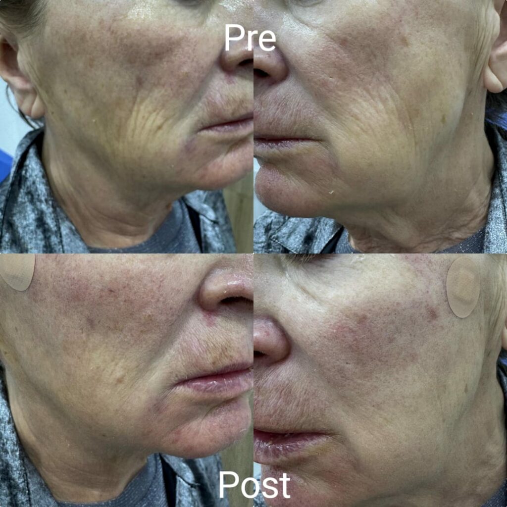 Immediate improvement in facial and cheek lines after Infini V10 injection in Hurghada