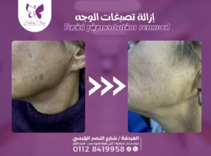 Facial pigmentation removal in Hurghada