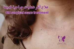Old surgical scars treatment in Hurghada