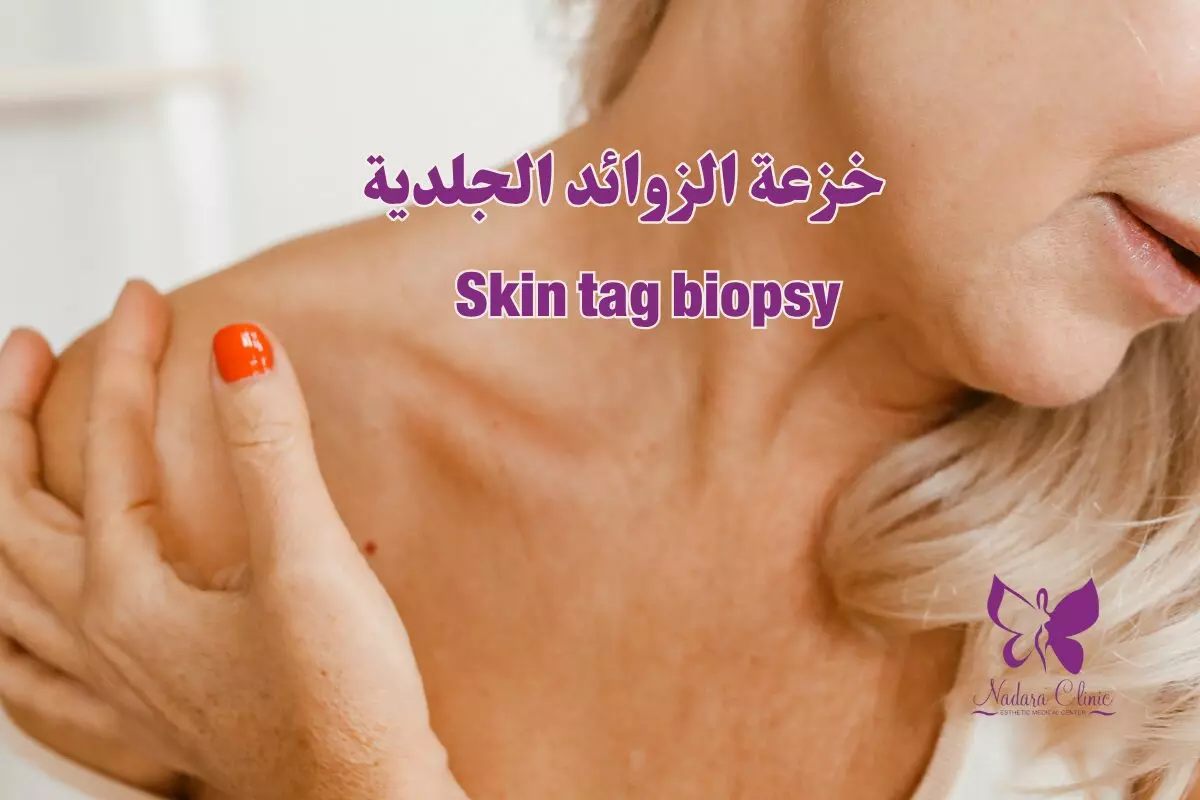 خزعة الزوائد الجلدية في الغردقة