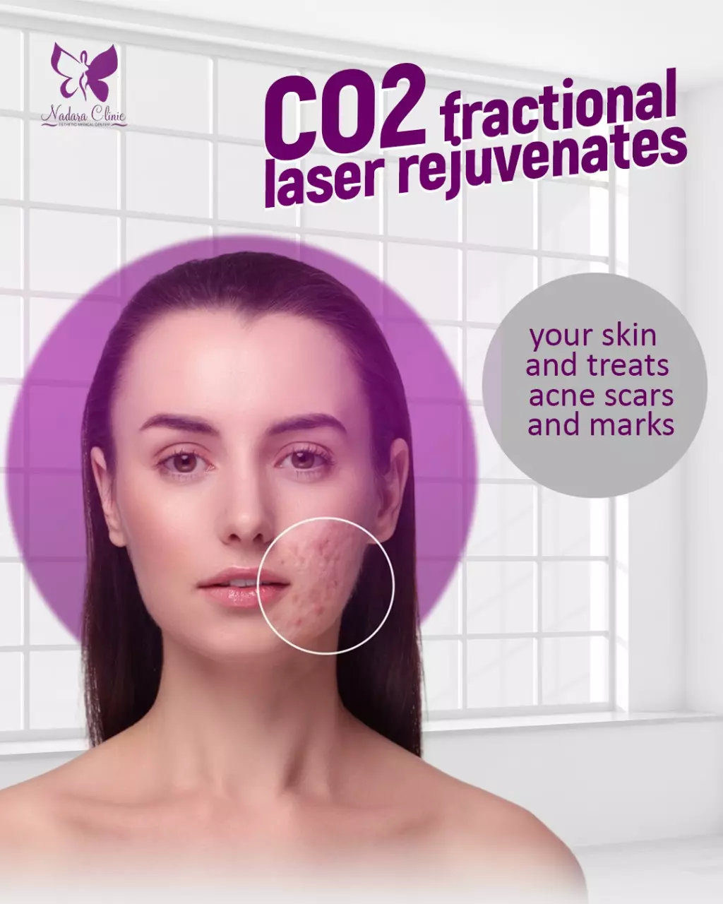 Fractional laser