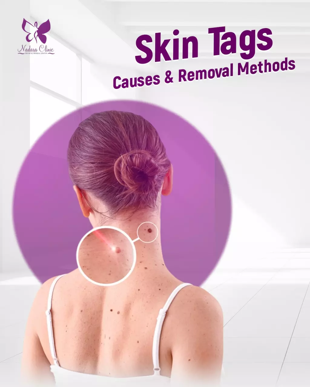 Skin tags: causes and methods for removing them