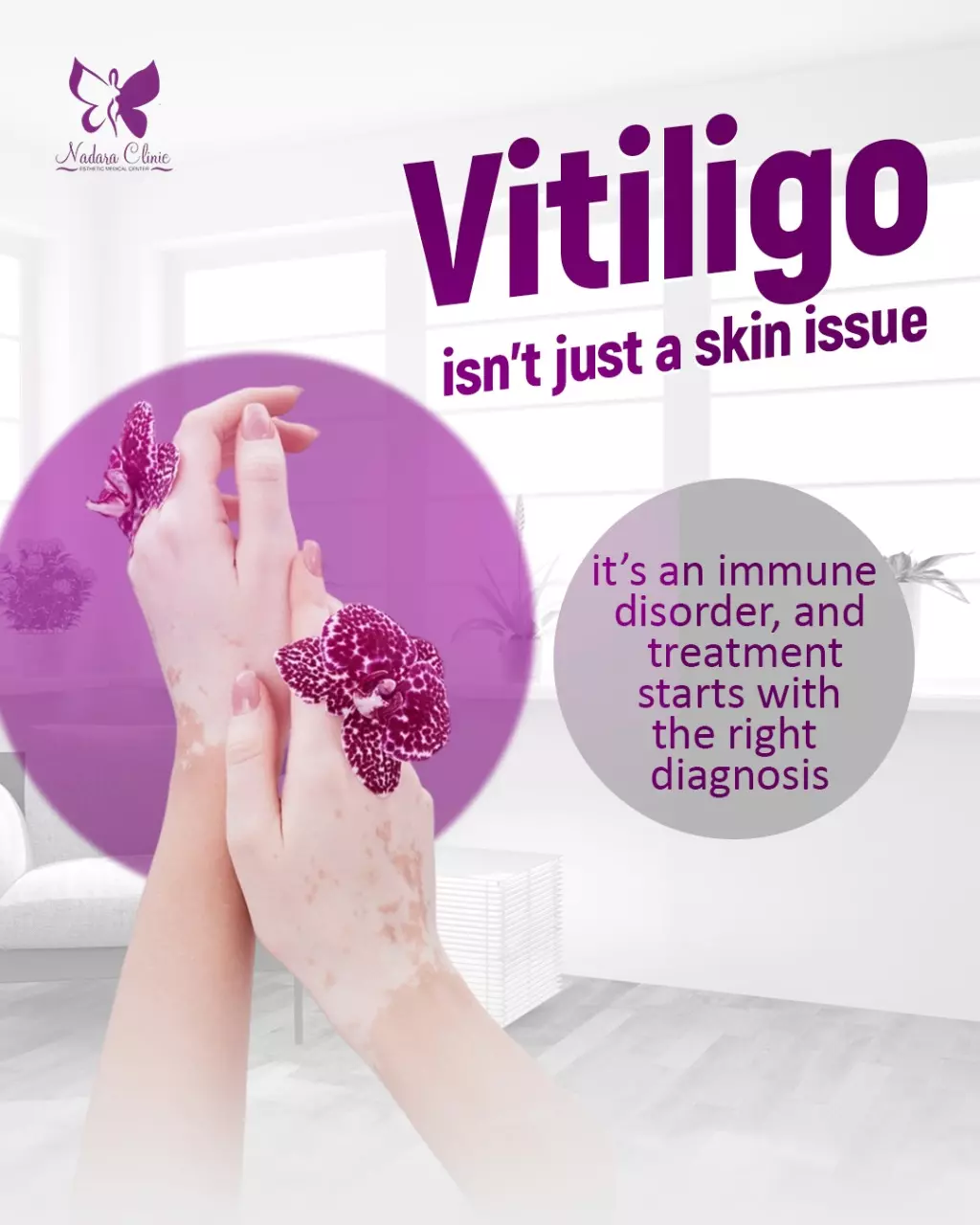 Vitiligo