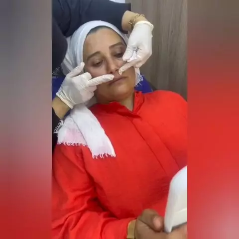 Lip filler and Botox session in Hurghada