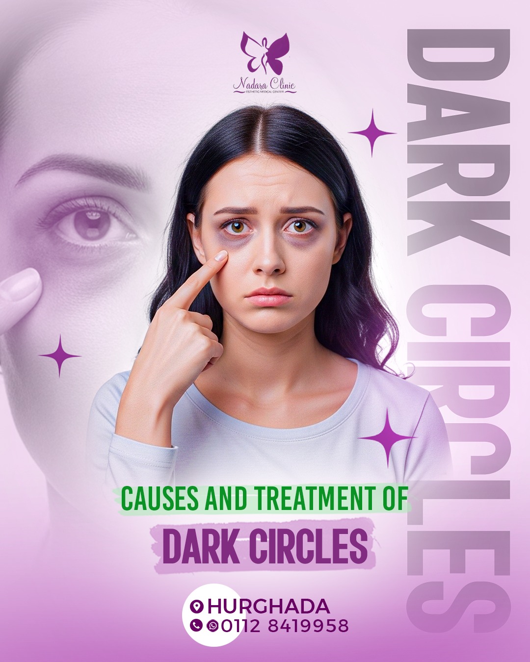 Causes and treatment of dark circles in Hurghada