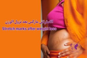 الاسترتش ماركس بعد نزول الوزن الغردقة