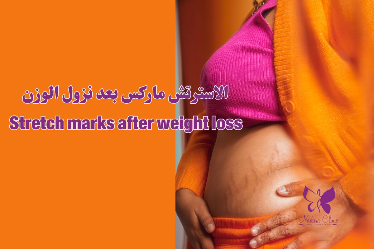 الاسترتش ماركس بعد نزول الوزن الغردقة