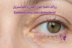 زوائد دهنية حول عين وكولسترول الغردقة